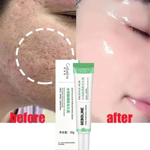 Crema Ácida Para Eliminar Los Poros, Salicílico, Que Se Enco