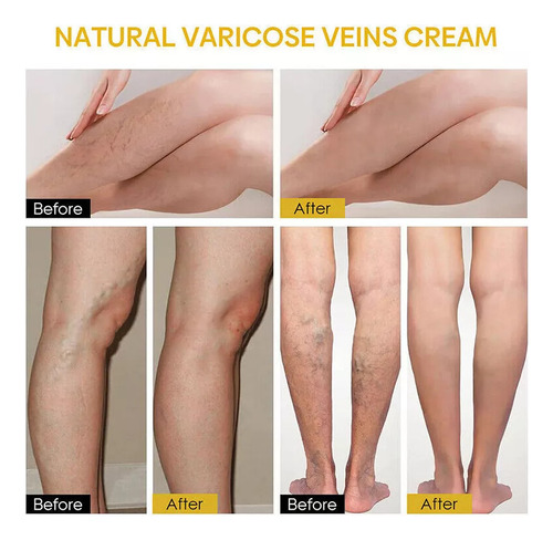 Crema Reparadora De Venas Varico Con Veneno De Abeja.1pc