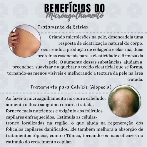 Dermaroller 0,5mm Derma Roller System 540 Agulhas Capilar