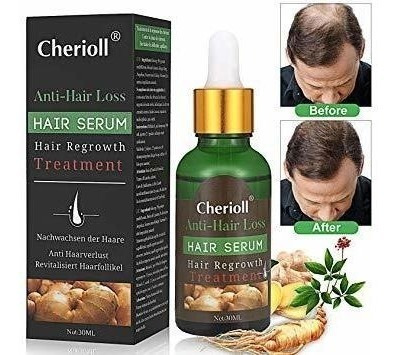 El Crecimiento Del Pelo En Suero, La Pérdida Del Cabello Y T