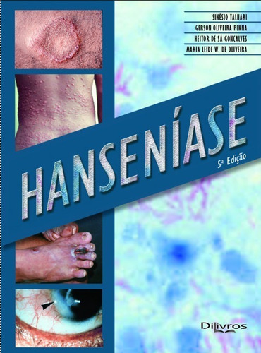 Hanseníase, De Sinesio Talhari. Editora Dilivros, Capa Dura, Edição 1ª Edição Em Português, 2014