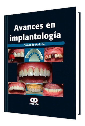 Avances En Implantología. 