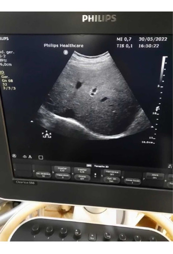 Ultrassom Philips Clearvue 550 Gineco Obstetrícia Vascular