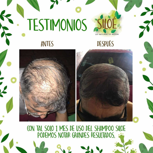 Adiós Calvicie, Alopecia, Psoriasis Pack 5 Shampoo Siloe