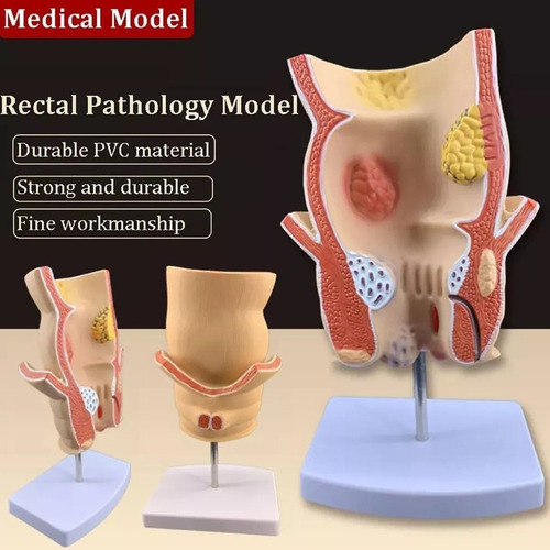 Yi Modelo Recto Patológico Humano, Modelo Recto Dañado