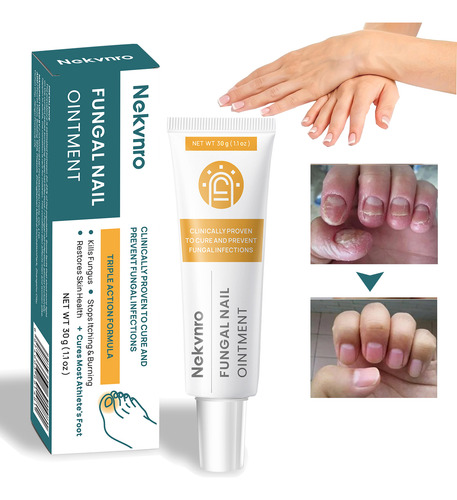 Nekvnro Crema De Renovación De Uñas Para Uñas De Pies Y Uñas