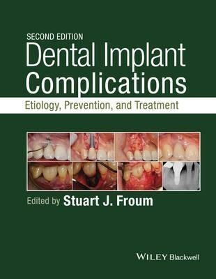 Dental Implant Complications - Stuart J. Froum
