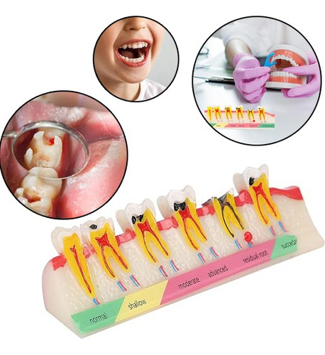 Modelo Portátil De Desenvolvimento De Cárie Dentária