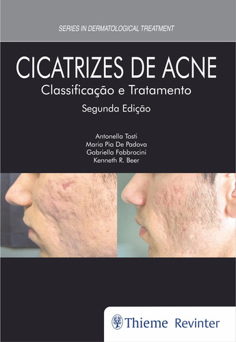 Cicatrizes de Acne: Classificação e Tratamento, de Tosti, Antonella. Editorial Thieme Revinter Publicações Ltda, capa dura em português, 2019