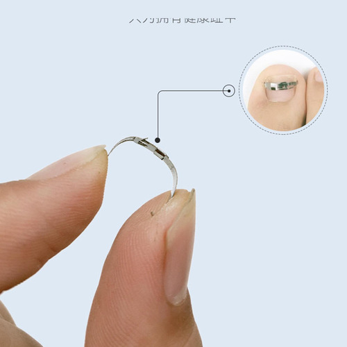 2 Uds Herramientas De Corrección De Uñas Encarnadas Clips
