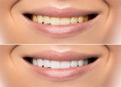 Carbón Activado Blanqueador Dental 100%