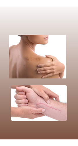 Kitocream Gel Para Cicatrices 10 Ml Kitoscell Día/noche Normal Día/noche