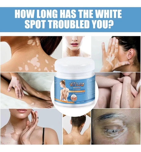 2 O Creme De Vitiligo Elimina Manchas E Marcas Brancas