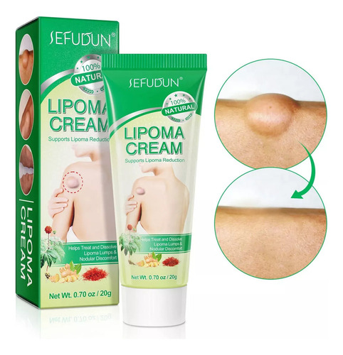 Creme Para Remoção De Lipoma, Creme Para Remoção De Lipoma,