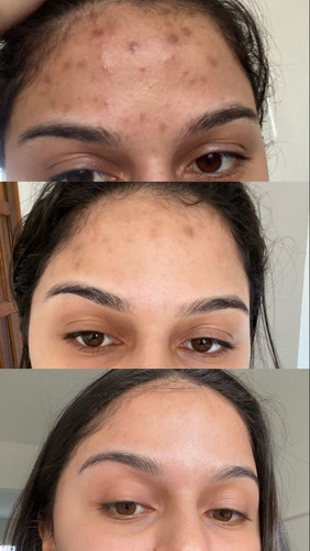 Vittacyd Gel 0.25mg Original Ótimo Manchas Acne Estrias 12+ Todo Tipo De Pele Noite