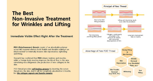 Neogenesis Pdo - Hilos Mono Para Levantamiento Facial Y Corp