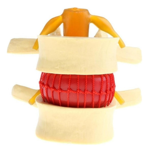 . 2x Modelo De Hernia De Disco Lumbar De La Columna