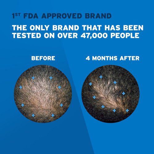 Tratamiento Para El Crecimiento Del Cabello Rogaine Extra St