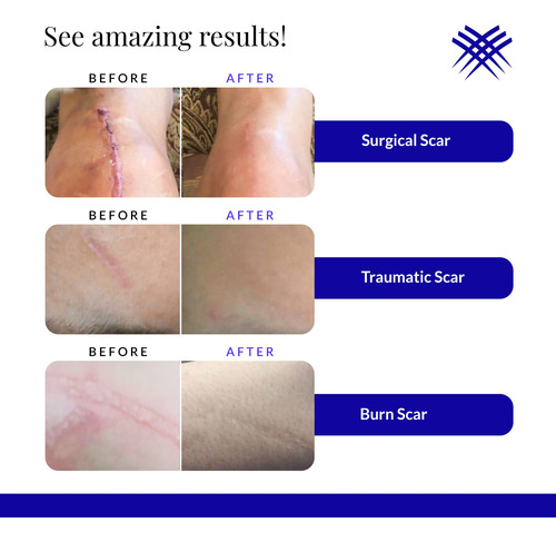 Crema Cicatricial Rejuvaskin Scar Esthetique Con Silicona 60