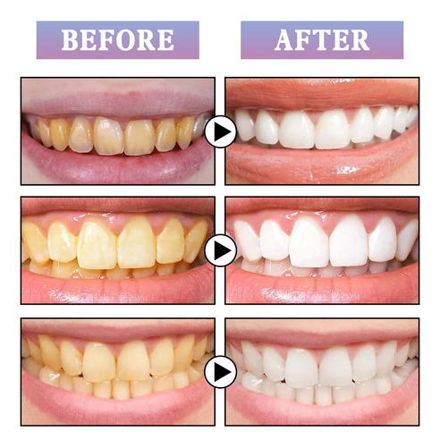 Q Tooth G Dentes Mais Brancosresultados Instantâneos G Teeth