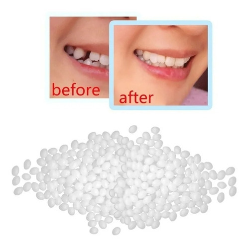 Imagen 2 de 6 de Kit Diente Provisorio Para Reemplazar Un Diente Easy Teeth