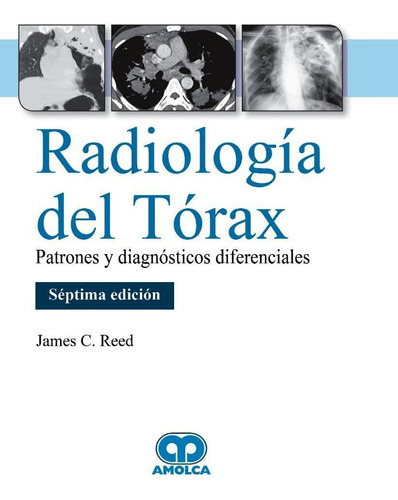 Radiologia De Torax, Patrones Y Diagnosticos Diferenciales