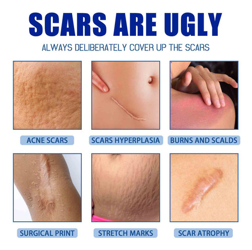 Fastest Removing And Scar Removing Cream Scar Gel Bruise Rep