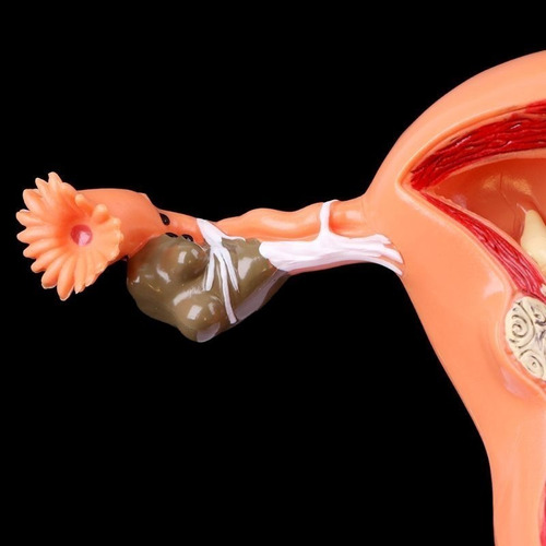 Modelo Anatómico De Ovario Uterino Con Patologías