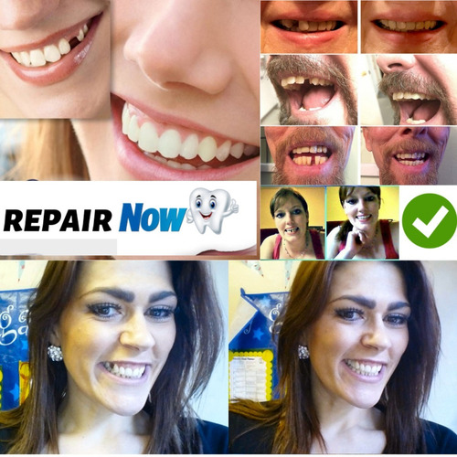 Dentadura Cosmética Postiza Termomoldeables Agnovedades