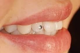 Imagen 1 de 3 de Piercing Dental En Córdoba