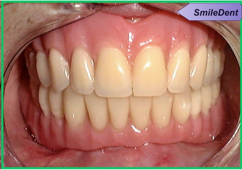 Imagen 2 de 5 de Prótesis Dentales Dentista A Domicilio,o Consul En 4 Días !!