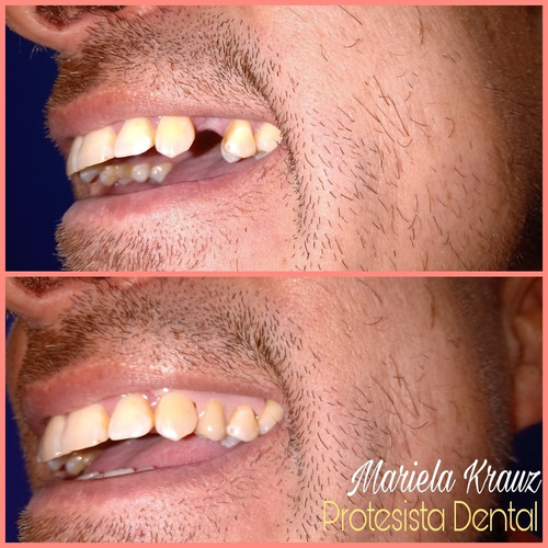 Arañitas Dentales En El Momento ,prótesis Dentales