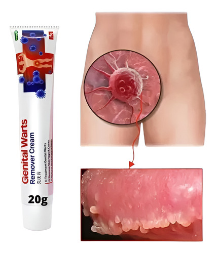 Creme Tira Verruga Hpv Coceiras Manchas Fungos Neutra