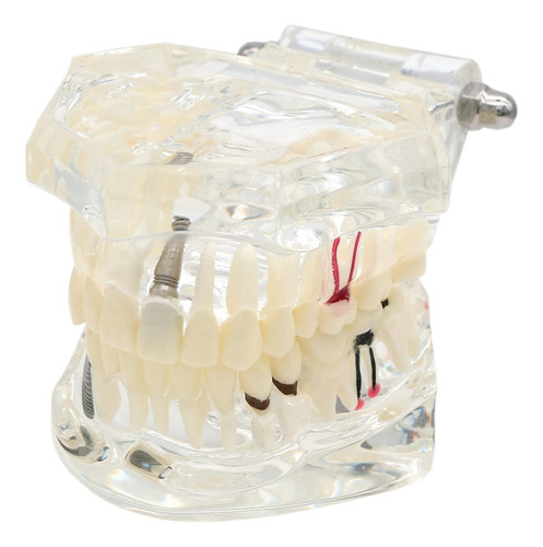 Modelo Dental Typodont Dentalmall 2001c Removible Estándar