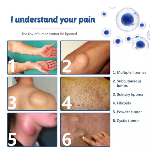 2× Crema Eliminación Lipomas Q Lipoma Crema Limpiadora