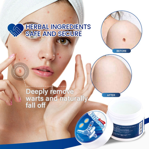 Crema Eliminadora De Lunares S Y Lunares, Rápida Y Eficaz, N