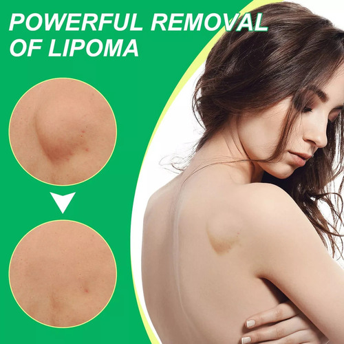 Creme Para Remoção De Lipoma, Creme Para Remoção De Lipoma,