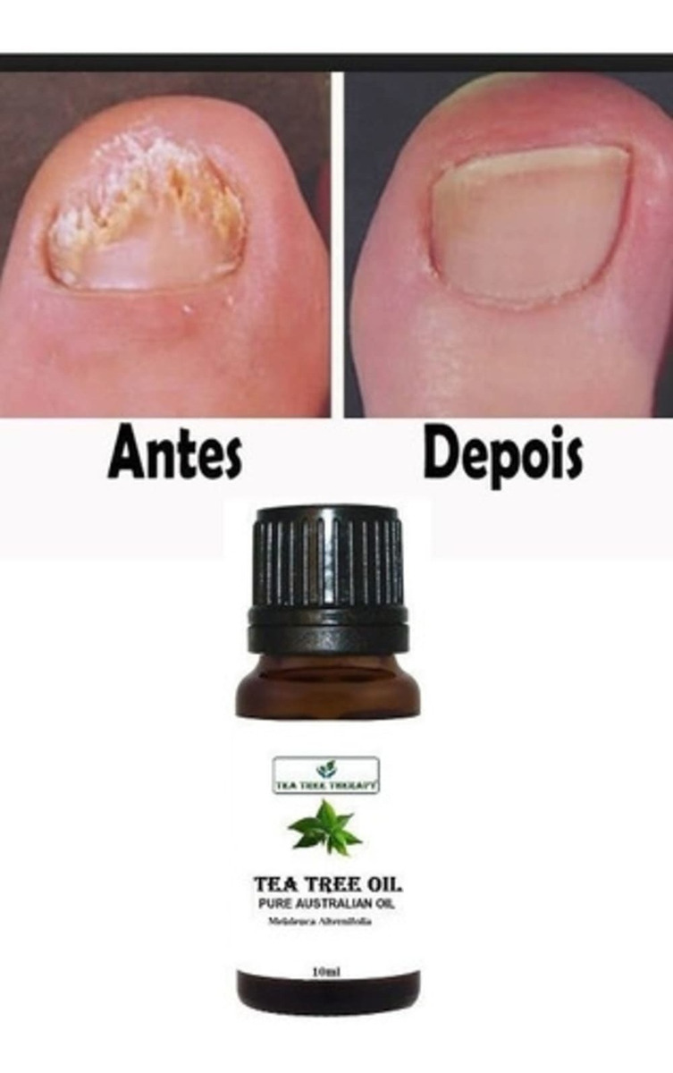 óleo De Melaleuca Para Micose De Unha Onde Comprar Óleo Essencial Melaleuca Tea Tree 10ml Saúde Unhas Micoses | MercadoLivre