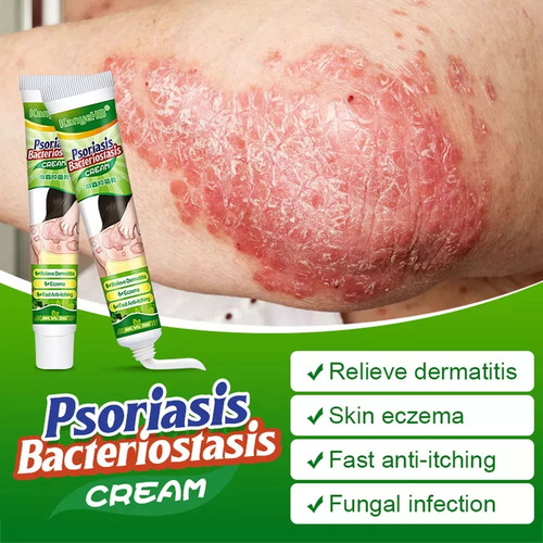 4 X Creme De Psoríase Para Remoção De Musgo Na Pele