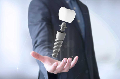 Implantes Dentales. Montevideo, San Jacinto Canelones