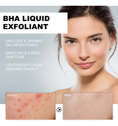 Exfoliante Líquido De Ácido Salicílico Con 2% De Bha Para El