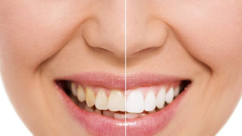 Tiras Blanqueadoras Dental 5d White Dientes Blancos 14 Pares