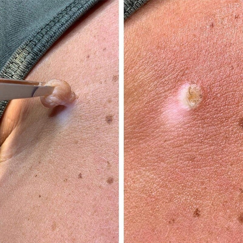 2 Unidades De Pomada Antisséptica Natural Para Remoção De Ve