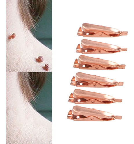 Set De 6 Pinzas De Cobre Para Verrugas