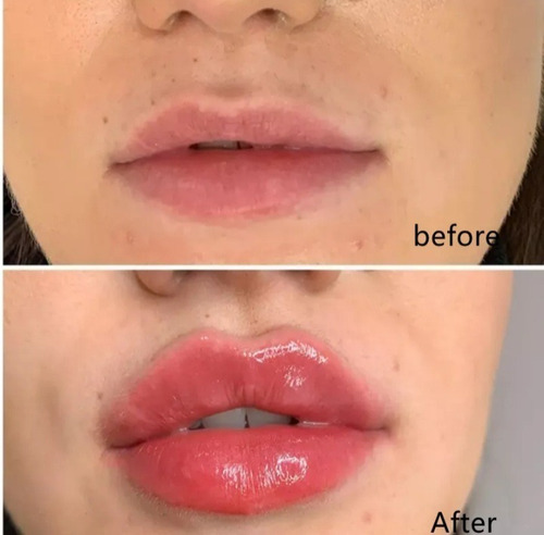 Imagen 3 de 9 de Lip Maximizer Voluminizador Y Engrosador De Labios