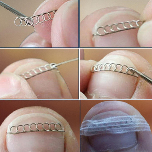 . Profesional For Uñas Encarnadas Reparación De Uñas