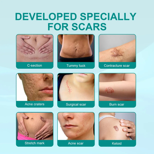 Gel Para Cicatrizes De Gravidez Dessalinizado E Dessalinizad