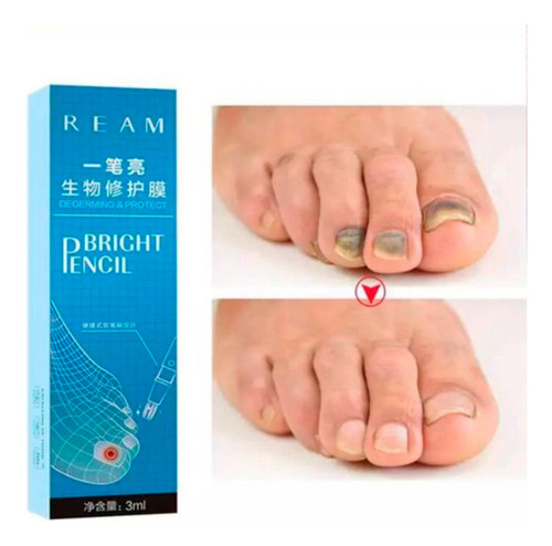 Lapiz Reparador Uñas Hongos Onicomicosis Micosis Pie Atleta