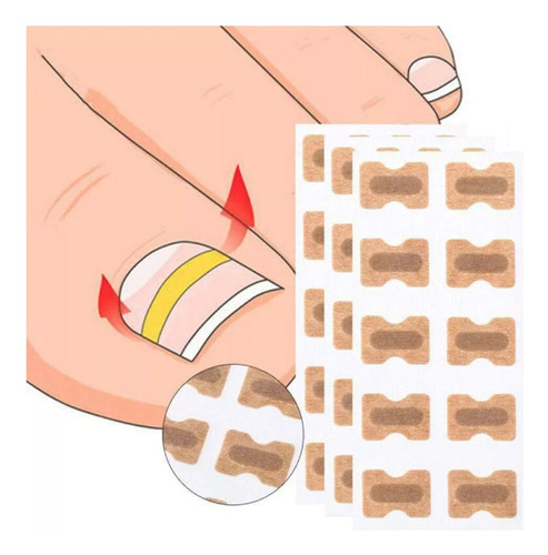 Parche Corrector De Uñas Encarnadas X 10 Unidades