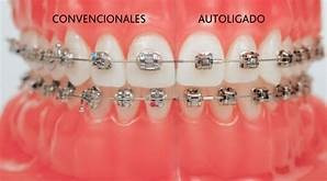 Imagen 4 de 6 de Ortodoncia Brackets- A Pura Cuota